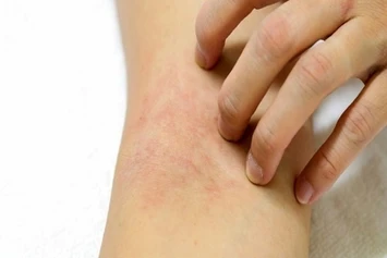 Leiden Sie an einem atopischen Ekzem?
