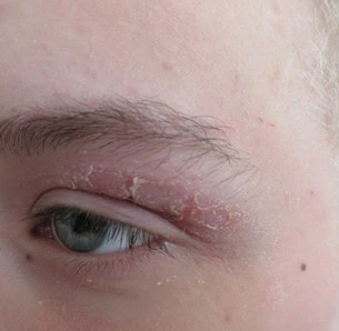 Vliv stravování na kožní nemoci z pohledu nutriční terapeutky