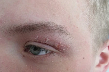 Der Einfluss der Ernährung auf Hauterkrankungen aus Sicht der Ernährungstherapeutin